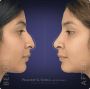 Atlanta’s Trusted Rhinoplasty Experts – Book a Consultation