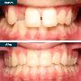 Invisalign® In Yonkers NY