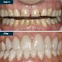 Porcelain Dental Veneers In Yonkers