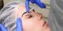Botox in Richmond Hill, Botox Cosmetic Injection