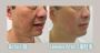 Best Sofwave Treatment in Richmond Hill