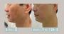 Best Sofwave Treatment in Richmond Hill