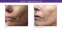 RF Microneedling in Richmond Hill