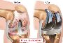Affordable and Advanced Knee Replacement Surgery in India