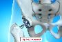 Low-Cost Hip Replacement Surgery in India | Edhacare