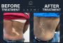 Effective Homeopathic Vitiligo Treatment and Kits.