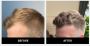 Hairline Transplant