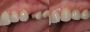 Get Dental Implants - The Ultimate Solution for Missing Teet
