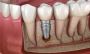 Restore Your Smile with Expert Dental Implants in Thane at I