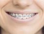 Why You Should See the Best Orthodontists in Thane for Your 