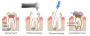 How to Find Right Dentist for Root Canal Treatment in Thane