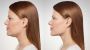 Effective Lipolaser Treatments for Double Chin Reduction