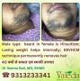 Permanent Hair Removal by VALEDA - EBVHCM - 40 Years Of Suc