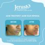 Best Acne Treatment in Chennai – Clear Skin with Advanced Ca