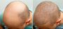 Hair Clinic in London – Expert Solutions for Hair Loss