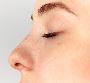 Rhinoplasty in Islamabad