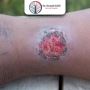 Get Quick & Safe Gangrene Treatment in Gujarat, India