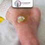 Expert Care for Diabetic Foot in Gujarat, India