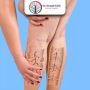 Advanced Varicose Veins Treatment in Ahmedabad – Dr. Krunal 