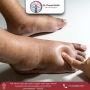 Improve Healing & Mobility with Best Diabetic Foot Treatment