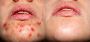 ACNE Treatment in Ahmedabad, Gujarat – Clear Skin & Expert C