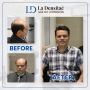 Unlocking Confidence: Hair Patch Solutions in Pune