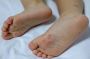 Child Care Programs Jandakot on Paediatric Athletes Foot