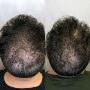 Hair Loss Treatment in Warrenton VA | Lifestyle’s MedSpa