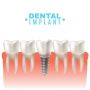 How Long Do Dental Implants Last? Expert Insights from South