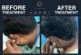  Side Effect-Free Vitiligo Treatment – Laxmi Vitiligo Centre