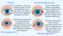 Eye Flu