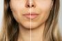 Lip fillers in Riyadh