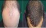 زراعة الشعر في الرياض