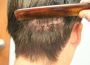 Hair Transplant in Riyadh