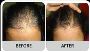 Available REGROWTH/BALDNESS Treatment  At Indiranagar