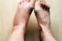 Ankle Swelling from Injury - Olwen Hospital
