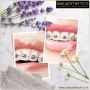    Dental Braces Treatment in Gurgaon | Dental Braces Cost 