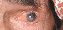 Book Your Slot For Abnormal Eyelash Trichiasis - Pari Shams