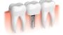 Explore Dental Implants in Tijuana Mexico - Expert Insights