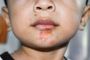 Understanding Different Types Of Impetigo Infections