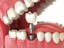 Dental Implants Port Coquitlam | PoCo Dental Group