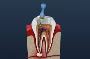 Root canal
