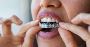 Trusted Invisalign Dentist Brampton