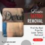 Tattoo Removal Before And After In Mckinney