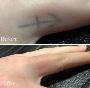 Get the Best Tattoo Removal Cost in McKinney