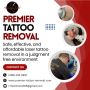  Premier Tattoo Removal in McKinney