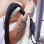 Best Tattoo Removal Quote In Mckinney
