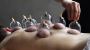 Soothe Pain with Cupping Therapy Treatment Today