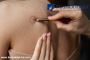 Expert Skin Tag Removal Clinic in Delhi