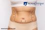 Full Body Liposuction Cost in Bangalore - Kosmoderma Clinic
